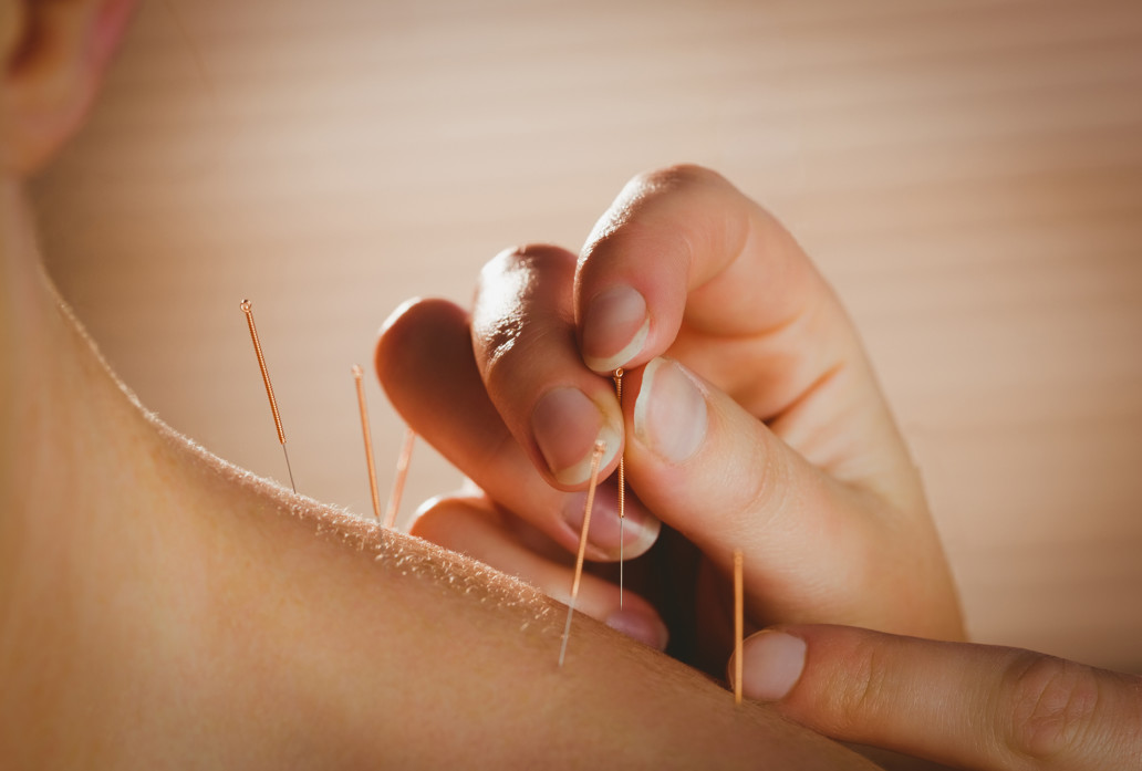 acupuncture acupressure therapy holistic intervention Endless Journey Hospice Omaha Nebraska